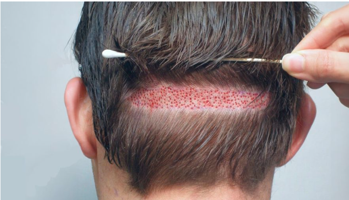 hair transplant cost in Lahore