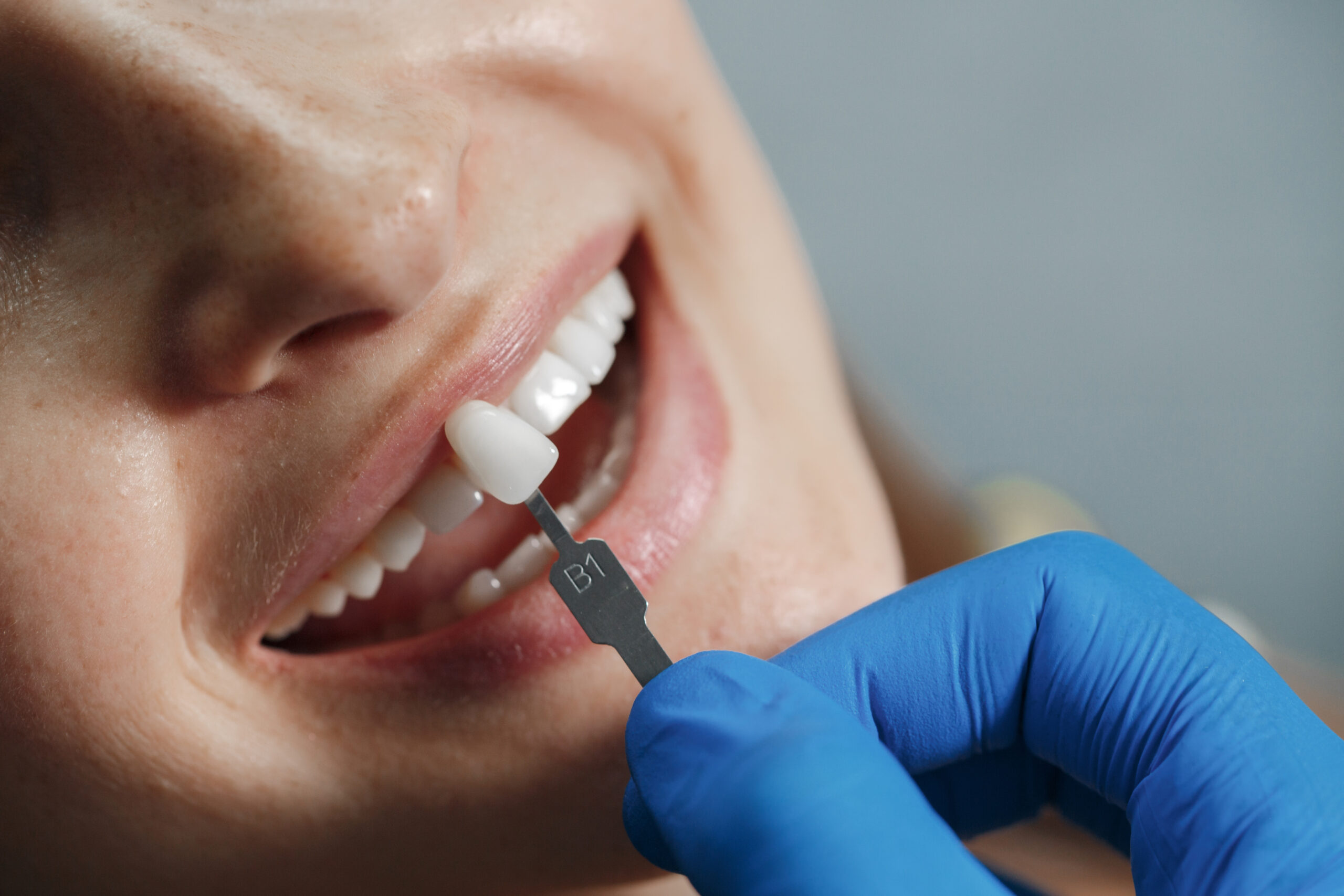 dental implants yuba city